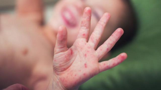 Инфекциозното отделение в Бяла Слатина се напълни с морбили